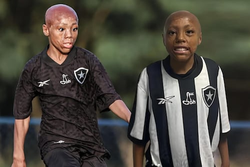 Sufrió QUEMADURAS GRAVES en el rostro con 1 año, superó la muerte y hoy Botafogo lo ha fichado (FOTO)