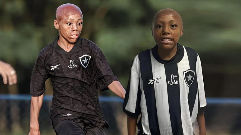Sufrió QUEMADURAS GRAVES en el rostro con 1 año, superó la muerte y hoy Botafogo lo ha fichado (FOTO)