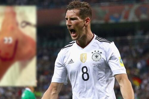¡Marca de guerra! Goretzka sufrió aparatoso CORTE tras el partido ante México (FOTO)
